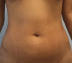 Liposuction