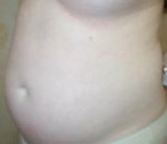 Liposuction