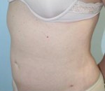 Liposuction