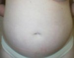 Liposuction