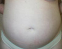 Liposuction