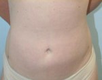Liposuction