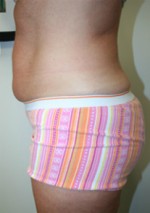 Liposuction