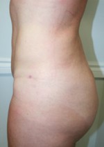 Liposuction