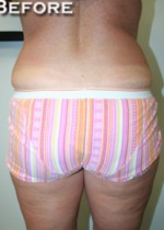 Liposuction