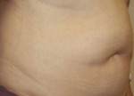 Liposuction