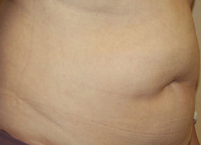 Liposuction
