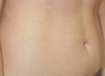 Liposuction
