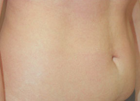 Liposuction