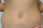 Liposuction
