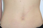Liposuction