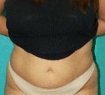 Liposuction