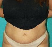 Liposuction
