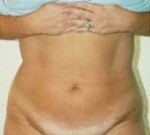 Liposuction