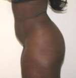 Buttock Augmentation