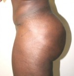 Buttock Augmentation