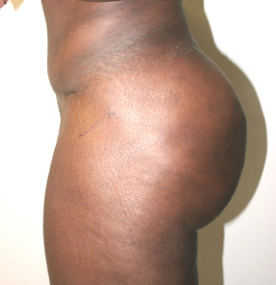 Buttock Augmentation