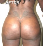 Buttock Augmentation
