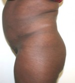 Buttock Augmentation