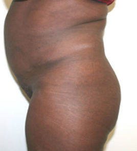 Buttock Augmentation