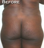 Buttock Augmentation