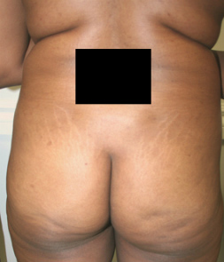 Buttock Augmentation