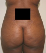 Buttock Augmentation