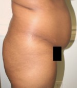 Buttock Augmentation