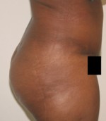 Buttock Augmentation