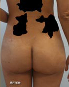 Buttock Augmentation