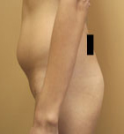 Buttock Augmentation