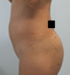 Buttock Augmentation