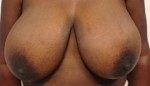 Breast Reduction (Reduction Mammaplasty)