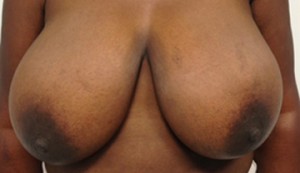 Breast Reduction (Reduction Mammaplasty)