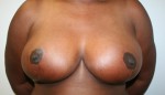 Breast Reduction (Reduction Mammaplasty)