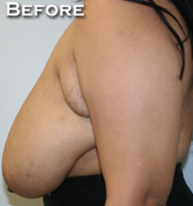 Breast Reduction (Reduction Mammaplasty)
