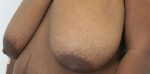Breast Reduction (Reduction Mammaplasty)