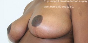 Breast Reduction (Reduction Mammaplasty)