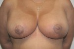 Breast Reduction (Reduction Mammaplasty)