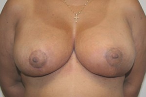 Breast Reduction (Reduction Mammaplasty)