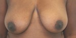 Breast Reduction (Reduction Mammaplasty)