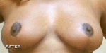 Breast Reduction (Reduction Mammaplasty)