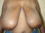 Breast Reduction (Reduction Mammaplasty)