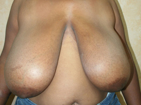 Breast Reduction (Reduction Mammaplasty)
