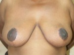 Breast Reduction (Reduction Mammaplasty)