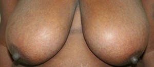 Breast Reduction (Reduction Mammaplasty)