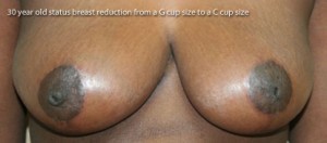 Breast Reduction (Reduction Mammaplasty)