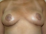 Breast Reduction (Reduction Mammaplasty)