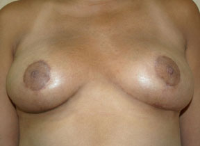 Breast Reduction (Reduction Mammaplasty)