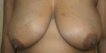 Breast Reduction (Reduction Mammaplasty)